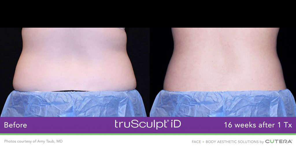 truSculpt® iD - Before and After Photos - Peel Weight Loss Clinic