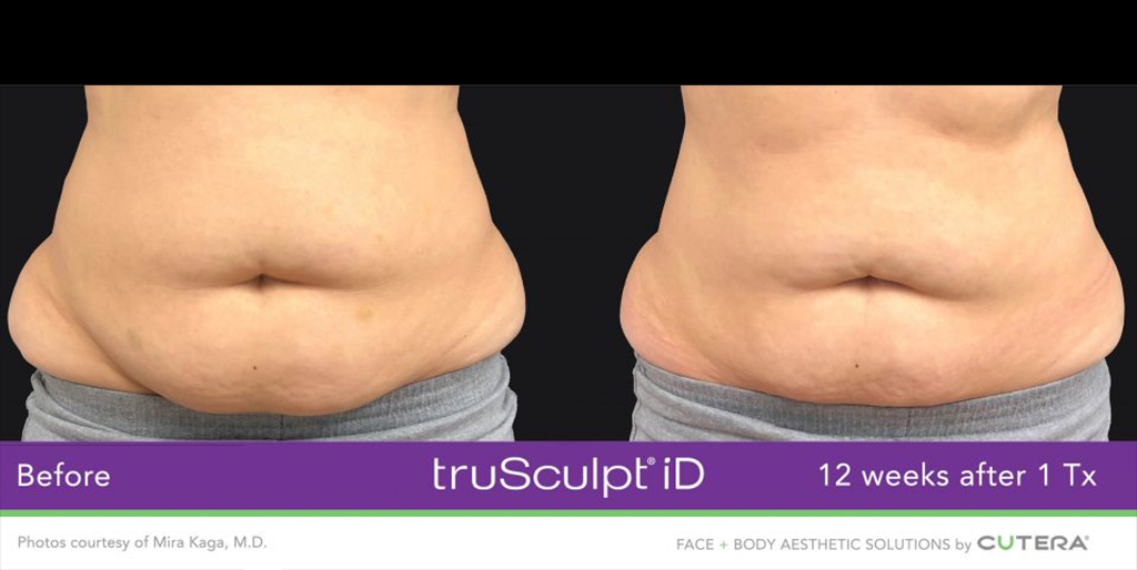 truSculpt® iD - Before and After Photos - Peel Weight Loss Clinic