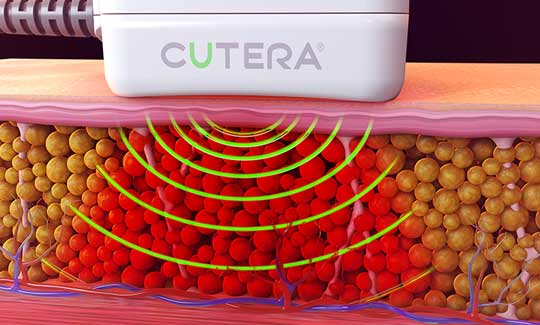 truSculpt® iD - How it works? - Peel Weight Loss Clinic truSculpt® iD - How it works? - Peel Weight Loss Clinic